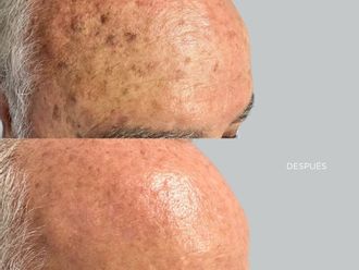 Peeling antes y después - 878449