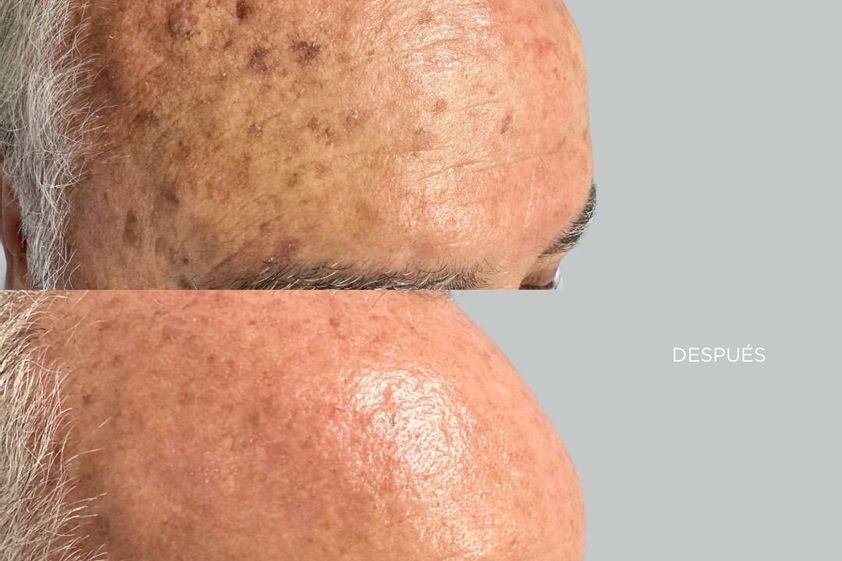 Peeling antes y después - 878449