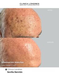 eliminación de manchas