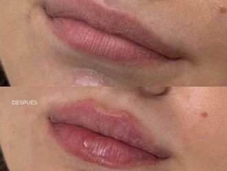 Ácido hialurónico antes y después - 878499