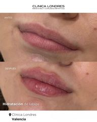 Hidratación de labios