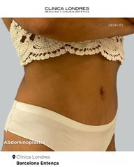 Abdominoplastia