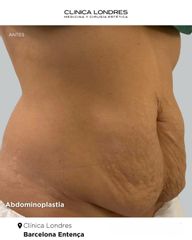 Abdominoplastia Antes