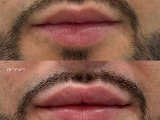 Ácido hialurónico antes y después - 878549