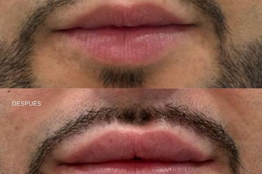 Ácido hialurónico antes y después - 878549