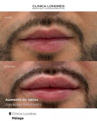 Aumento de labios