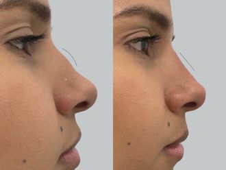 Rinomodelación antes y después - 878563