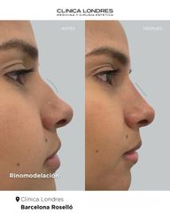 Rinomodelación con ácido hialurónico