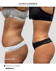Liposucción