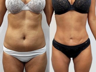 Liposucción antes y después - 878684