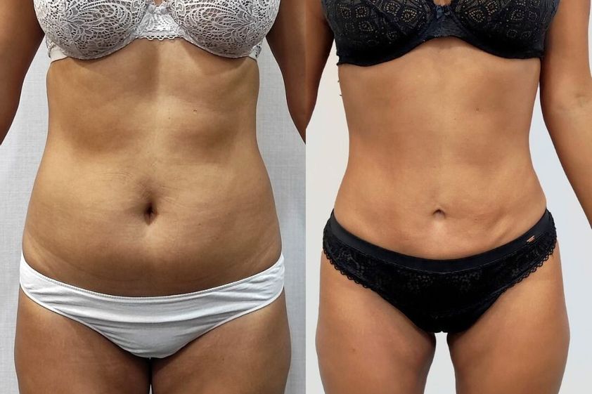 Liposucción antes y después - 878684