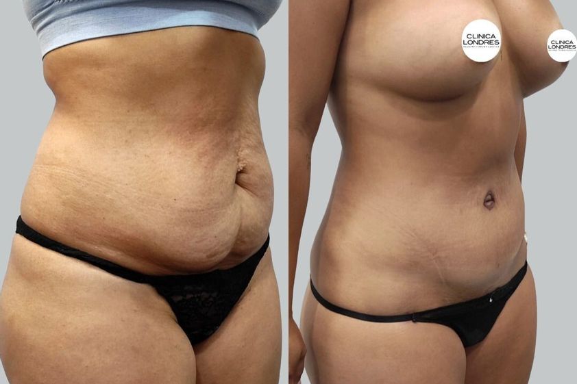Abdominoplastia antes y después - 878876