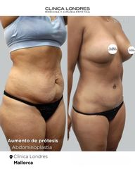 Aumento de prótesis + Abdominoplastia