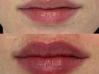 Aumento labios antes y después - 879062