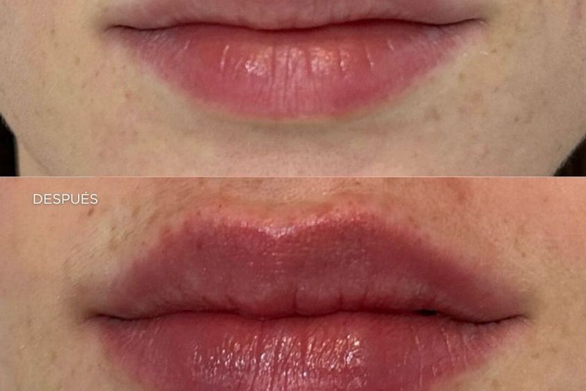 Aumento labios antes y después - 879062