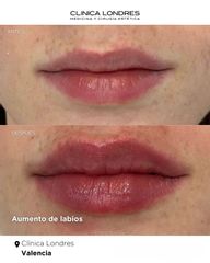 Aumento de labios