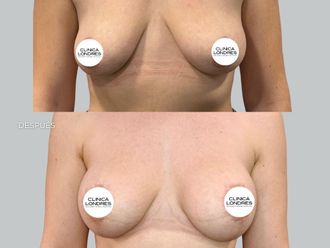 Mastopexia antes y después - 879063