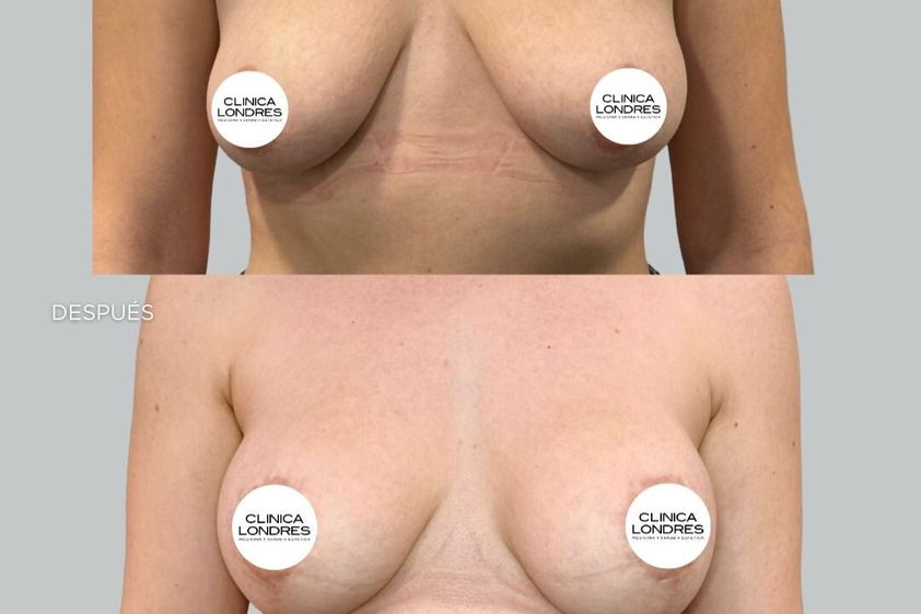 Mastopexia antes y después - 879063