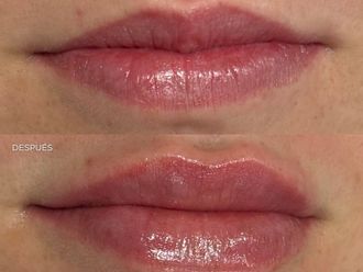 Aumento labios antes y después - 879200