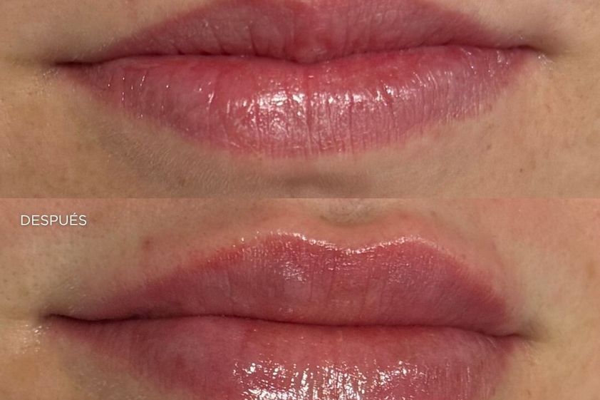 Aumento labios antes y después - 879200