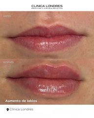 Aumento de labios