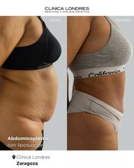 Abdominoplastia con Liposucción
