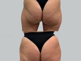 Aumento glúteos antes y después - 879570