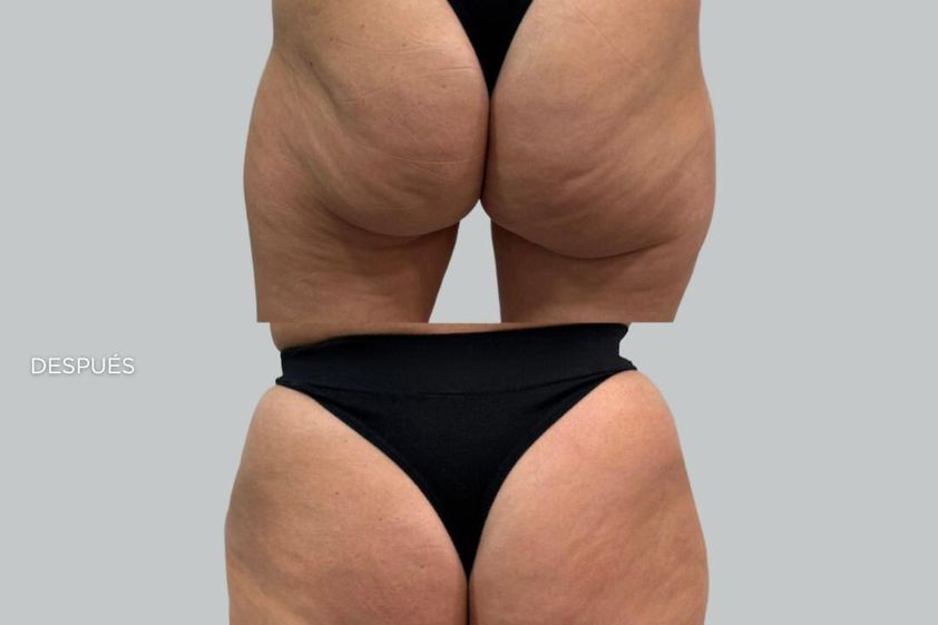 Aumento glúteos antes y después - 879570