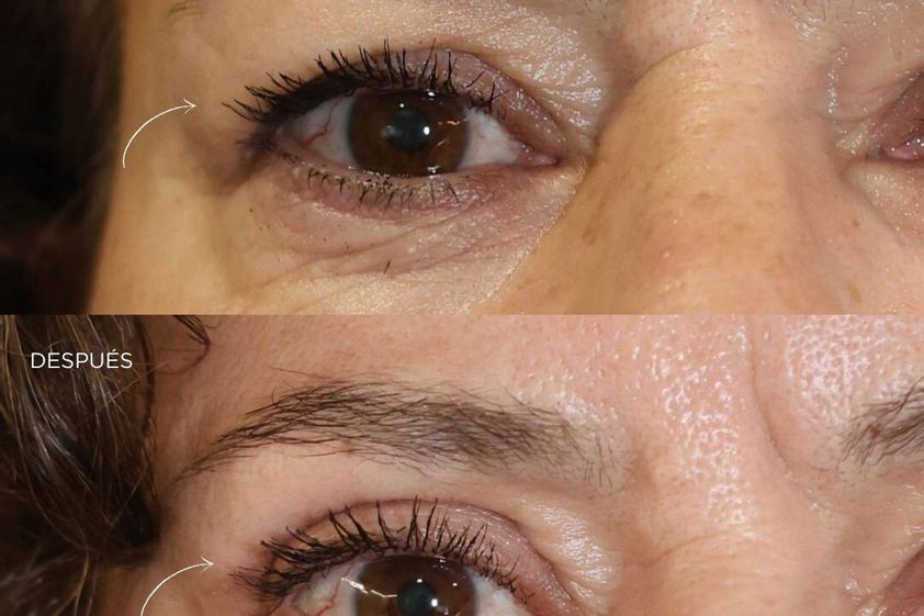 Blefaroplastia antes y después - 879722