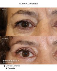 Blefaroplastia