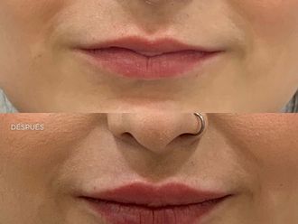 Aumento labios antes y después - 879949