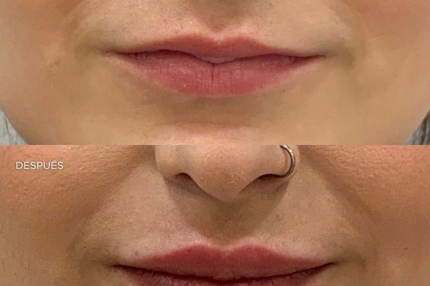 Aumento labios antes y después - 879949