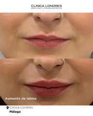 Aumento de labios