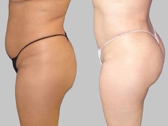 Liposucción antes y después - 880084