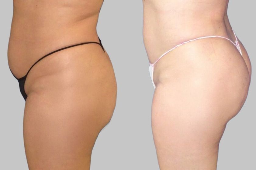 Liposucción antes y después - 880084