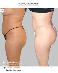 Liposucción con transferencia a glúteos