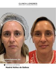 Estimuladores de colágeno