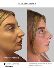 Rinoseptoplastia - Clínica Londres