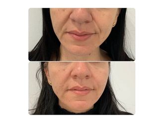 Rejuvenecimiento facial - 661793