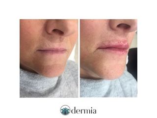 Dermia - Aumento de labios