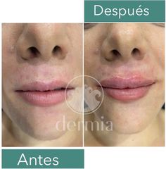 Aumento de labios - Dermia
