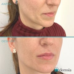 Aumento de labios - Dermia