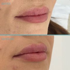 Aumento de labios - Dermia