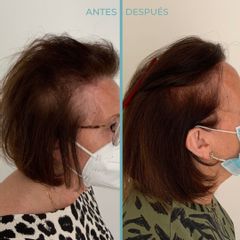 Alopecia - Dermia