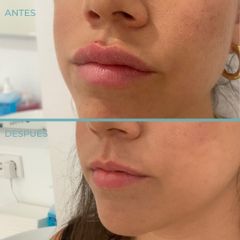 Aumento de labios - Dermia
