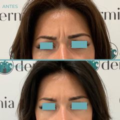 Rellenos faciales - Dermia