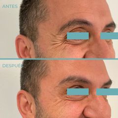 Rellenos faciales - Dermia