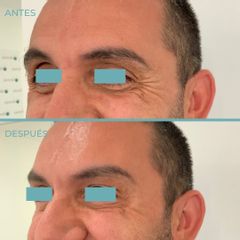 Rellenos faciales - Dermia