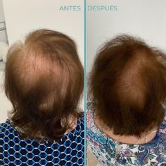 Alopecia - Dermia