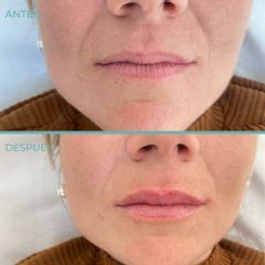 Aumento de labios - Dermia